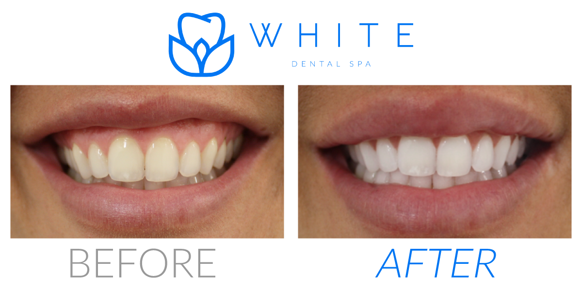 Best Teeth Whitening Orange County, CA - Dentist OC